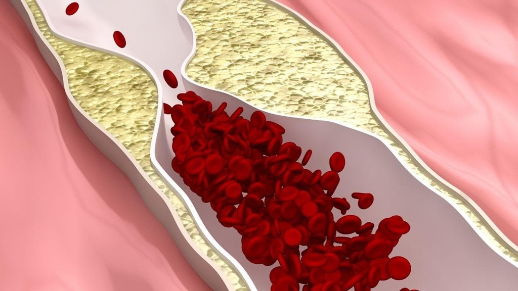 Arteriosclerosis y la importancia de una dieta equilibrada | Dietista Vigo