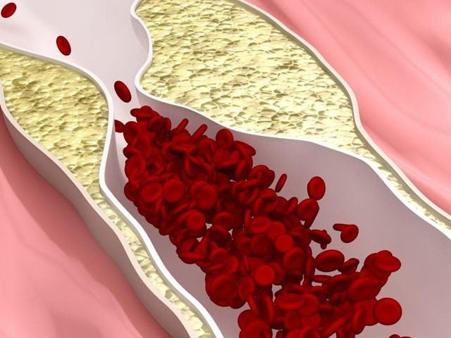 Arteriosclerosis y la importancia de una dieta equilibrada | Dietista Vigo