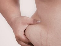 Obesidad: cambiar la relación con la comida