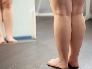 ¿Qué es el lipedema y cómo influye la nutrición?